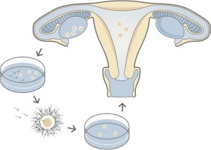 In-vitro fertilization (IVF) process